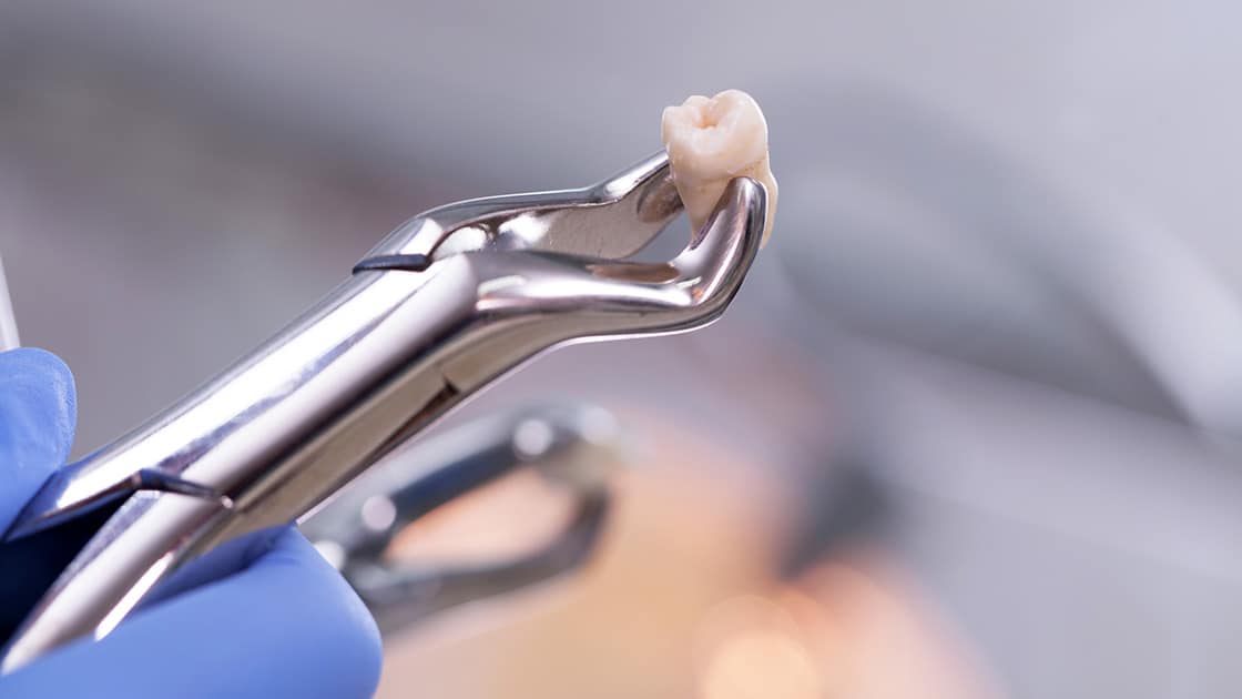 tooth extraction